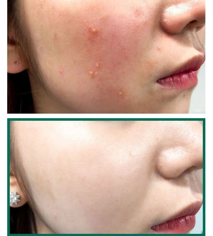 Miracle Truecica pad for reducing redness and acne scars