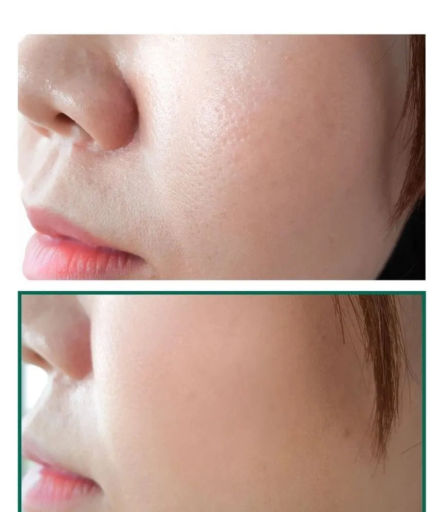Daily cleanser with AHA BHA PHA for acne scars reduction
