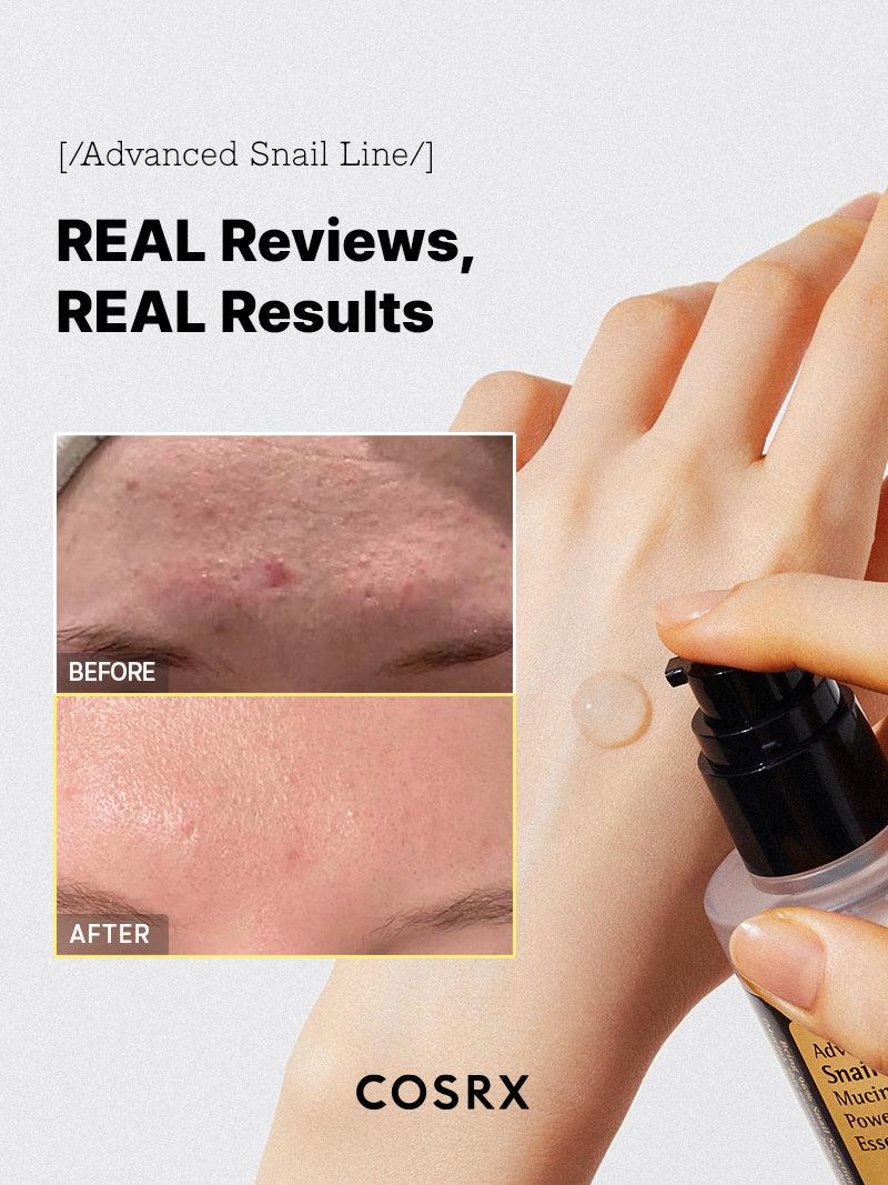 COSRX Advanced Snail 96 Mucin Power Essence: Non-comedogenic formula for acne-prone skin